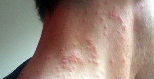 Quelles Consequences En Cas De Piqure Les Chenilles Processionnaires Quelles Consequences En Cas De Piqure Les Chenilles Processionnaires